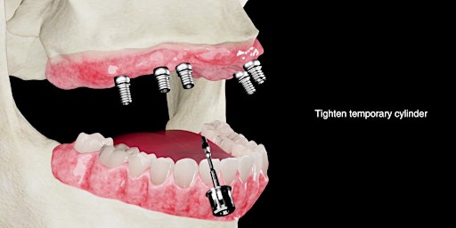 Imagen principal de Guided Implant for Full Arch Restoration I Indianapolis, IN I $799