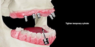 Immagine principale di Guided Implant Placement for Full Arch Restoration I Dallas, TX I $799 