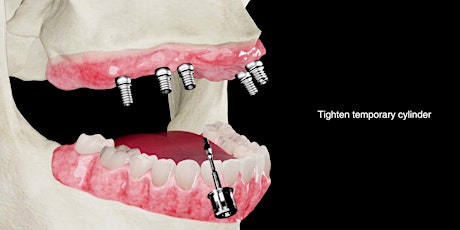Guided Implant Placement for Full Arch Restoration I Omaha, NE I $799