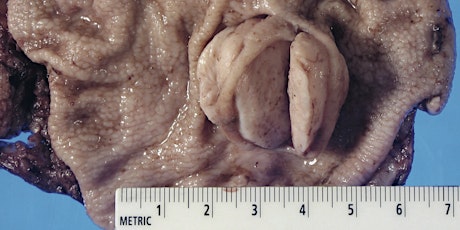 Cancer Treatment Discovery! Form Fits Function primary image