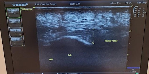Immagine principale di Introduction to Point Of Care Ultrasound (POCUS) Of The Foot June 2024 