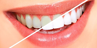 Hauptbild für Charlotte Teeth Whitening/Tooth Gem  Course