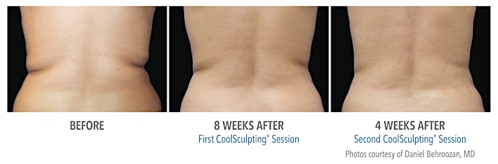 
		Get Back to You  Coolsculpting® Elite Event image
