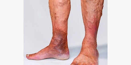Vascular: Varicose Veins Latest Management and Indication for Treatment