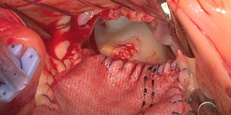 SURGICAL TECHNIQUES TO PREVENT AORTIC VALVE PATIENT PROSTHESIS MISMATCH