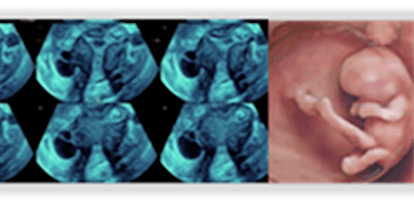 Advances in GynaecoIogic Imaging & First Trimester Ultrasound Series, Day 3