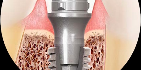 Restoring a Morse Taper Implant System for Singles @ Andover Sample Lab