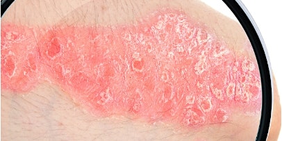 Immagine principale di Atopic Dermatitis (Eczema) Study - Embrace Relief, Embrace Life! 