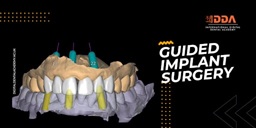 Image principale de Getting Started with Guided Implant Surgery with ExoPLAN