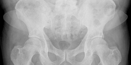 Ask the Experts: Joint Replacement with Lupus primary image