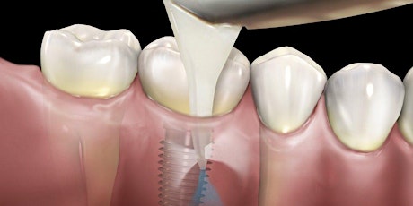 Imagen principal de What Should We Know About Peri-implant Disease? - Diagnosis and Treatment