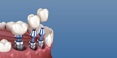 Imagem principal de Implant Re-Rehabilitation: The Operative Sequences For A Successful Outcome