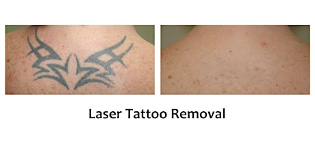The Toowoomba Laser Tattoo Removal Experience primary image