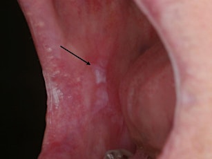 Differential diagnosis of pre-malignant oral lesions and Early detection an  primärbild