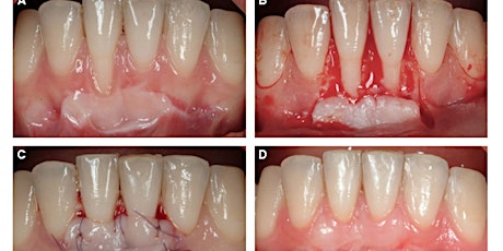 Imagem principal do evento Periodontal Plastic Surgery