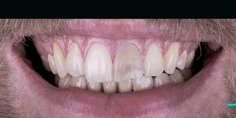 Management of the Dark Central Incisor