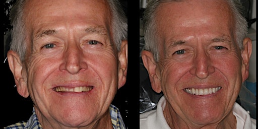 June Denture Bootcamp primary image