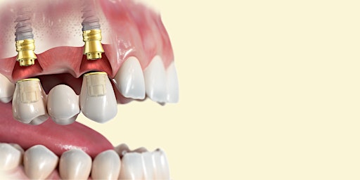 Primaire afbeelding van Dental Implant Restorative Series Part 4:  Multi-Unit Restorations