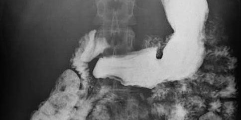 Dysphagia Grand Rounds: Esophageal dysphagia primary image