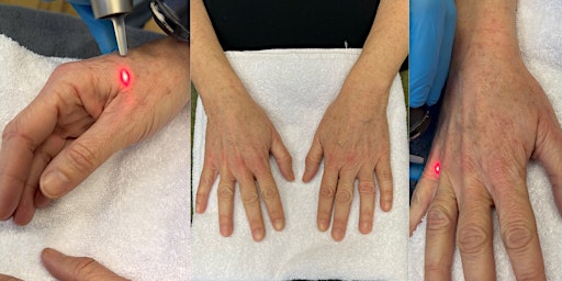 Skin rejuvenation / Anti-Ageing Laser Skin Treatment with Picosure primary image