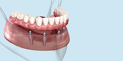 Primaire afbeelding van Implant-Supported Fixed Detachable/Hybrid Restorations