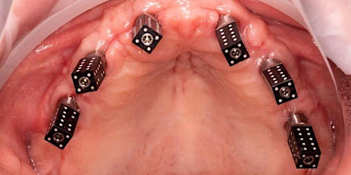 Immagine principale di The Digital Workflow of Full Arch Implant Dentistry( All on X )Live Surgery 