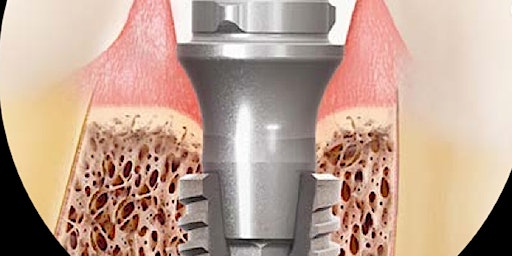 Image principale de Restoring a Morse Taper Implant System for Singles