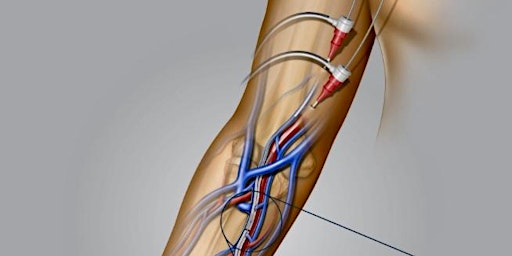 Primaire afbeelding van WavelinQ EndoAVF Dinner with Midwest Radiology