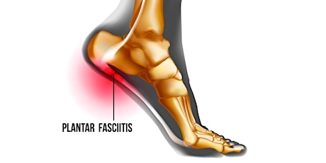 Plantar Fasciitis Crash Course with Q&A