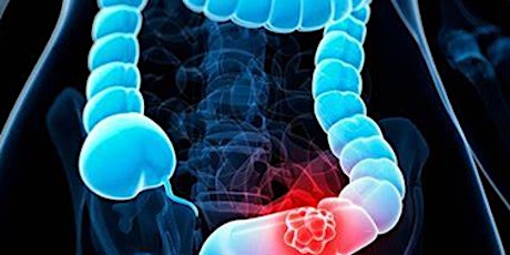 Colorectal Cancer:   Epidemiology, Risk Factors, and Prevention