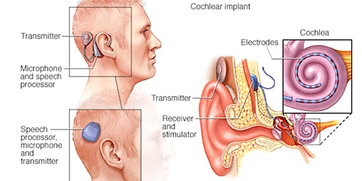 Immagine principale di Treatment Options for Hearing Loss: The ENT's Perspective 