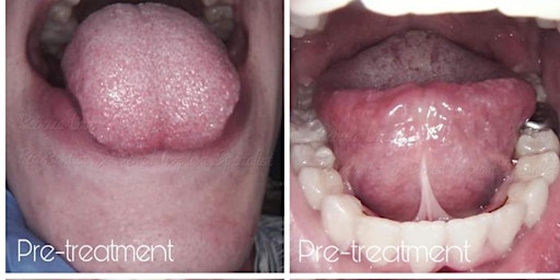 Laser Frenectomy Workshop - Deephaven, MN primary image