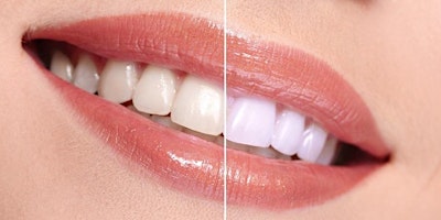 Primaire afbeelding van Orlando FL Teeth Whitening/Tooth Gem Course