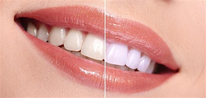 Primaire afbeelding van Savannah GA Teeth Whitening/Tooth Gem Course