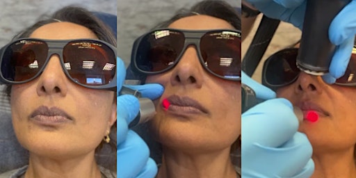 Lip Lightening and Rejuvenate the Lip Colour Laser Treatment with Picosure primary image