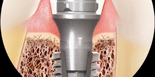 Imagen principal de Restoring a Morse Taper Implant System for Singles at Artisan Dental Lab