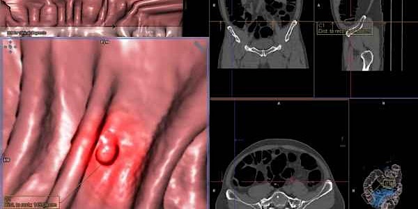 CT Colonography for Radiologists (Virtual Course)
