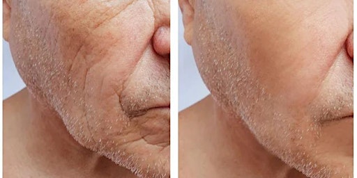 Collagen Boosting Biostimulators for Facial Contouring - LiveStream
