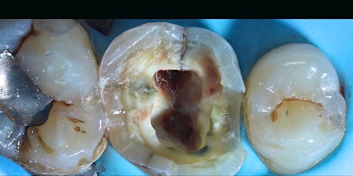 CRACKED TOOTH SYNDROME primary image
