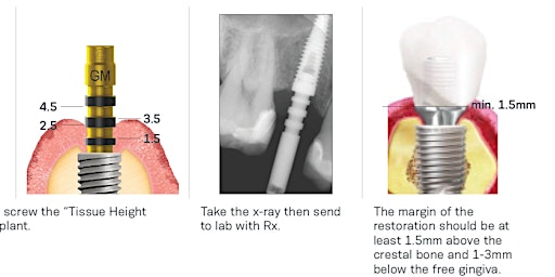 Restoring a Morse Taper Implant System for Singles @ Gnathodontics Dental Lab  primärbild