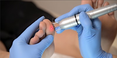 K-Laser’s Ablative Capabilities: Verrucae, Nail Infections and Matricectomy