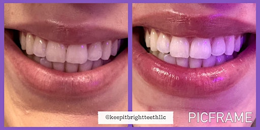 Spring Fling SALE ! Get 30% OFF Teeth Whitening  primärbild
