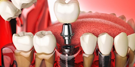 Cfare jane Implantet Dentare?
