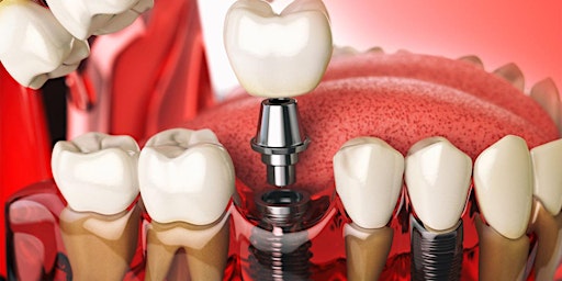 Primaire afbeelding van Cfare jane Implantet Dentare?