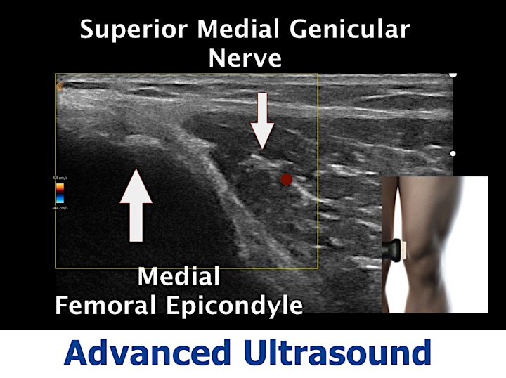 Ultrasound  Guided  Interventional Pain Management image