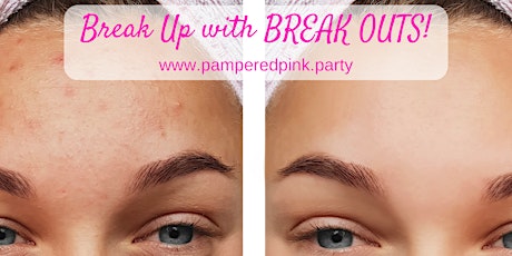 BREAK UP with your BREAK OUTS! How To Overcome Acne and Heal Your Skin! primary image