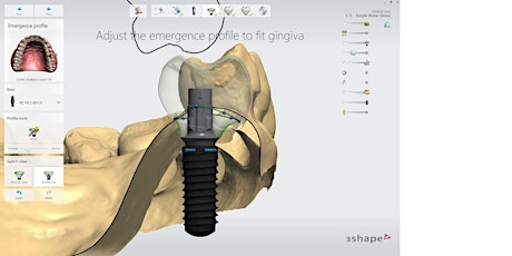 Webinaire 3Shape Implant Studio et couronne transvissée